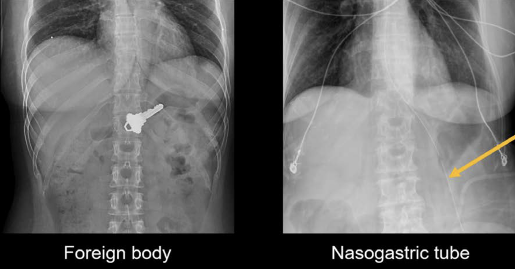 Abdominal X-ray uses