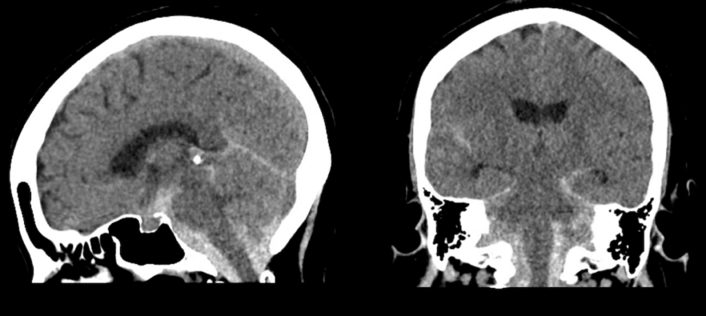 CT Brain Case 004