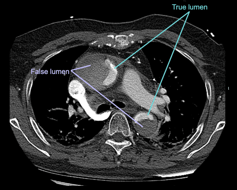 CT Case 006 LITFL CT Scan Interpretation