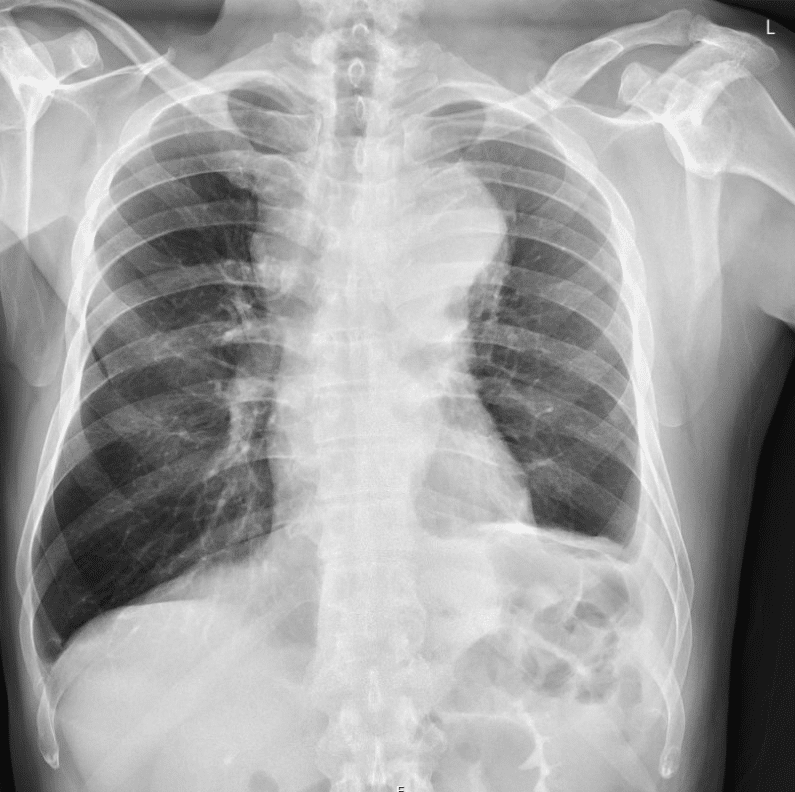 CT Case 038 • LITFL • CT scan interpretation