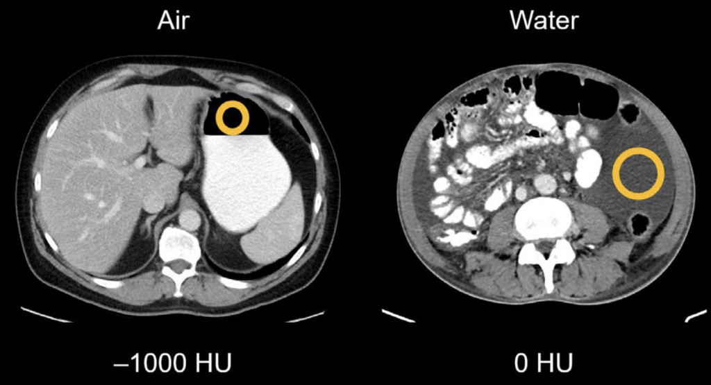 CT abdomen Hounsfield units Air Water