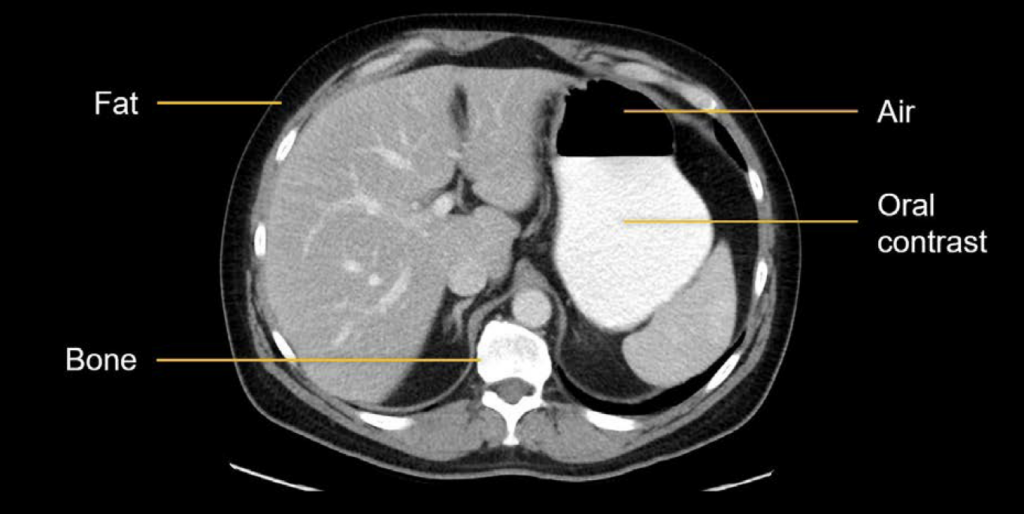 CT abdomen attenuation 2