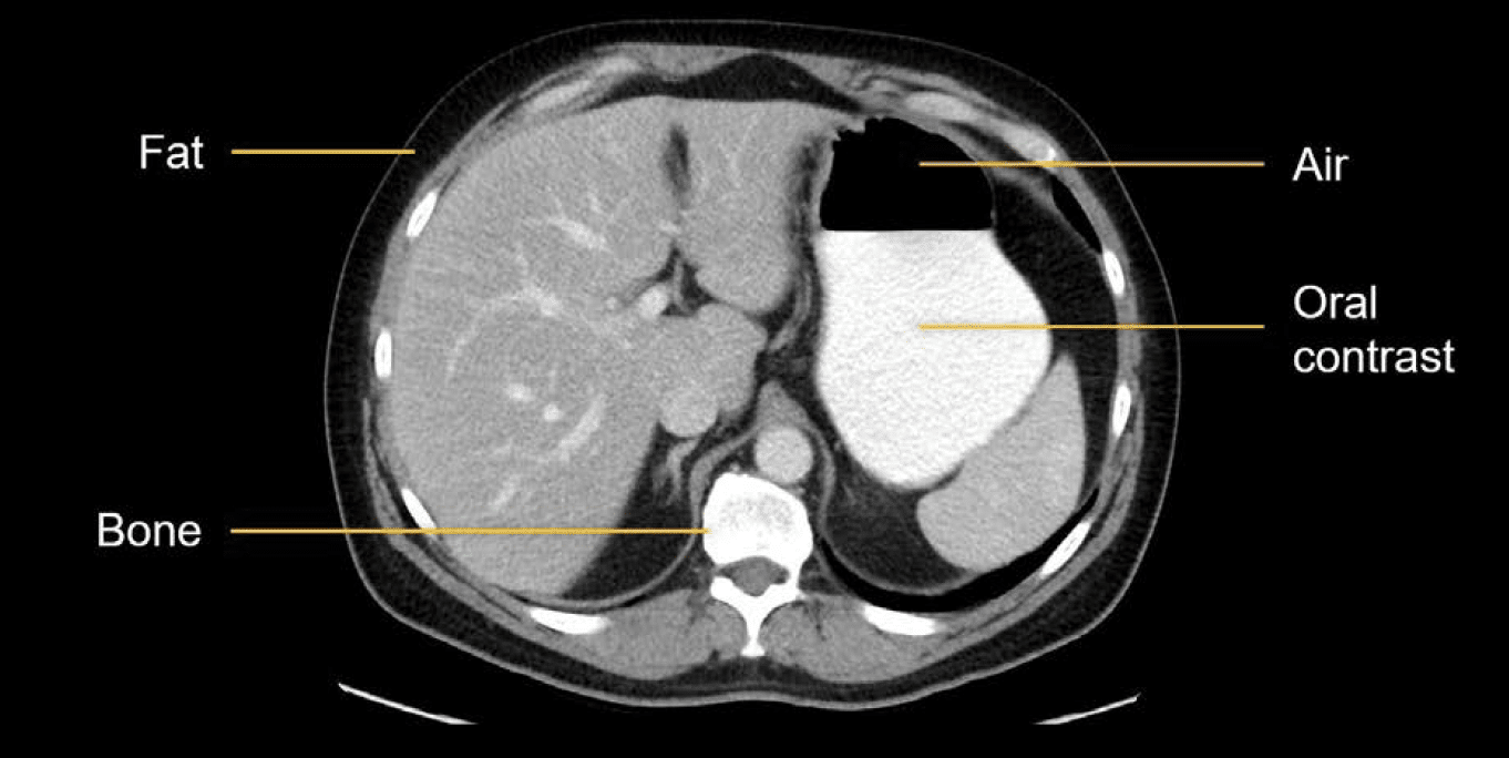 Abdominal CT Attenuation • LITFL • Radiology library