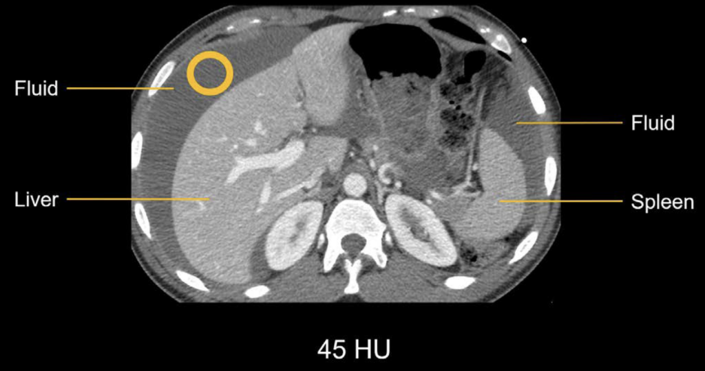 Abdominal Ct Attenuation • Litfl • Radiology Library