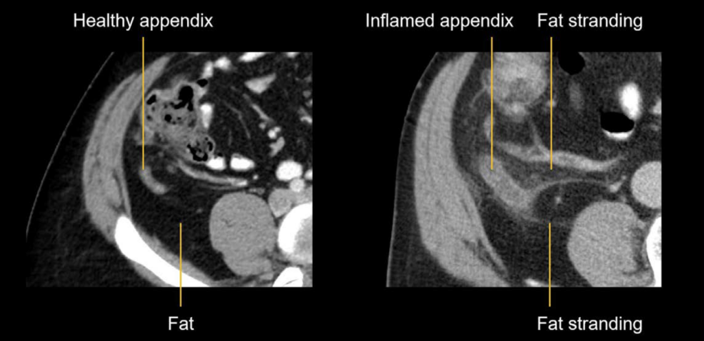 CT abdomen fat stranding appendix