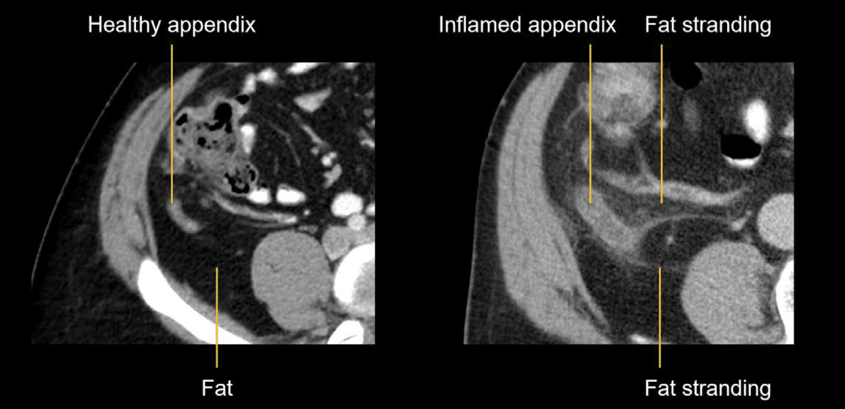 CT Abdomen Fat Stranding Appendix 