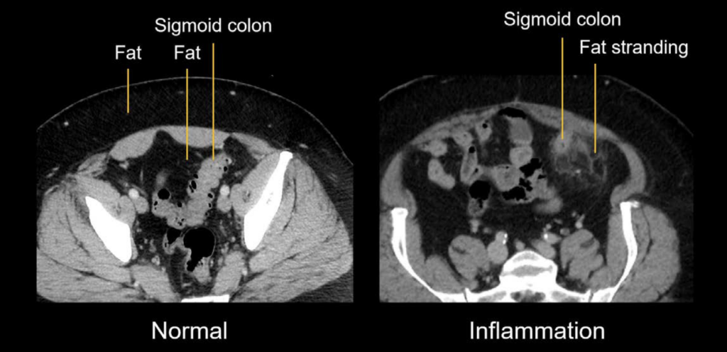 CT abdomen fat stranding sigmoid