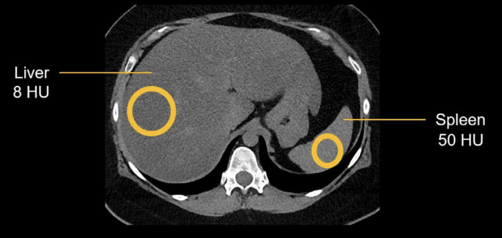 CT abdomen fatty infiltration liver