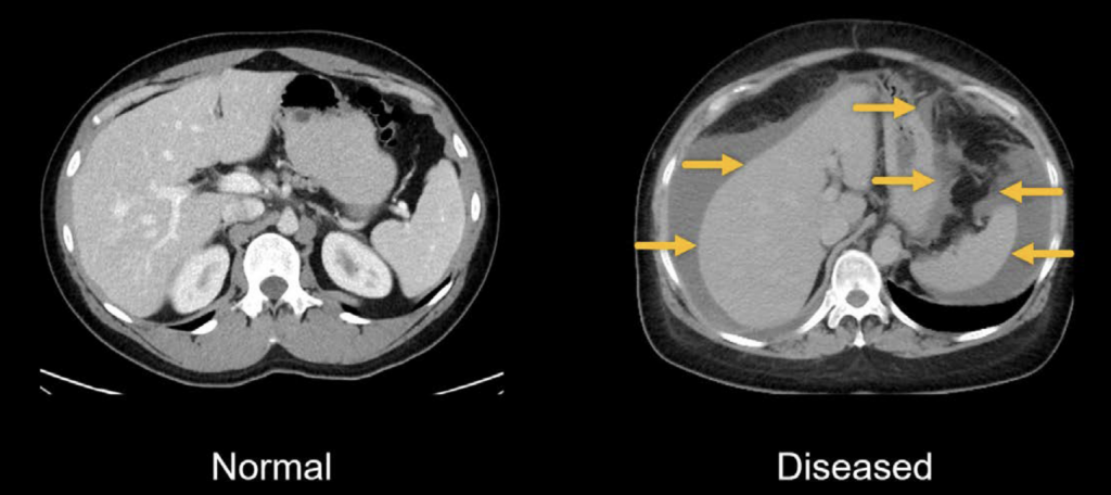 CT abdomen fluid in four places