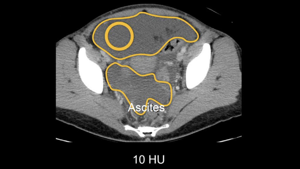 CT abdomen pelvic fluid attenuation