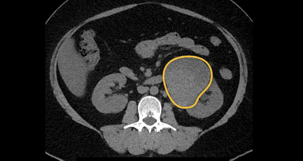 CT abdomen renal mass attenuation 1