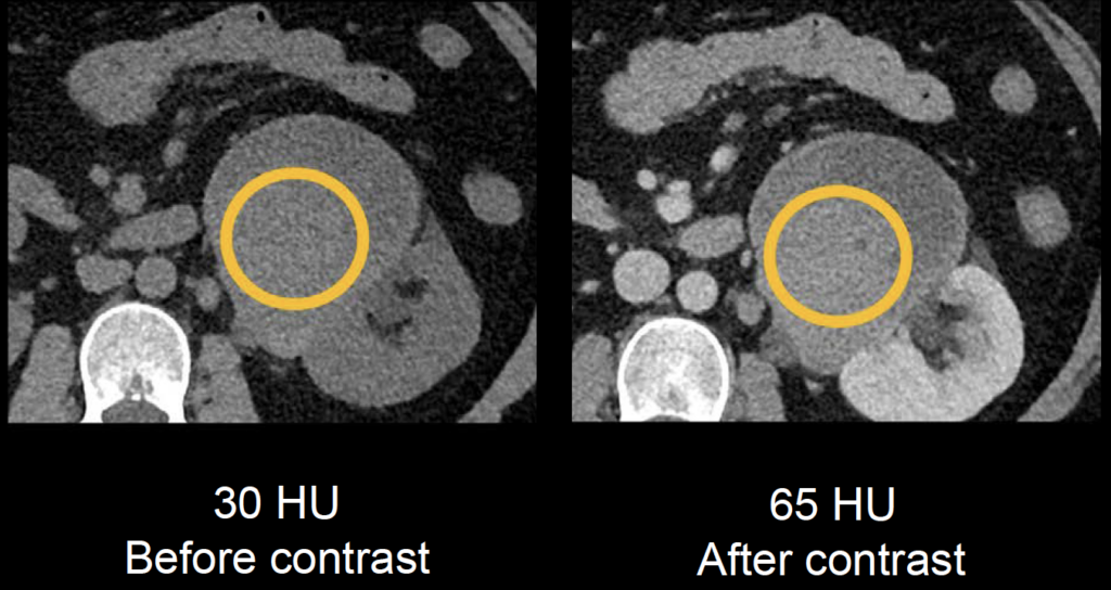 CT abdomen renal mass attenuation 2