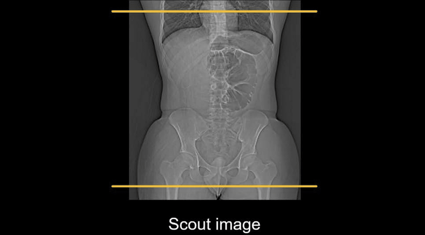 Abdominal CT Planes LITFL Radiology Library