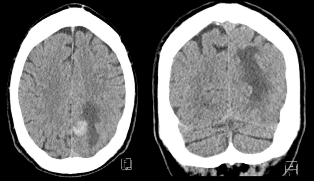 LITFL CT Case 001 03