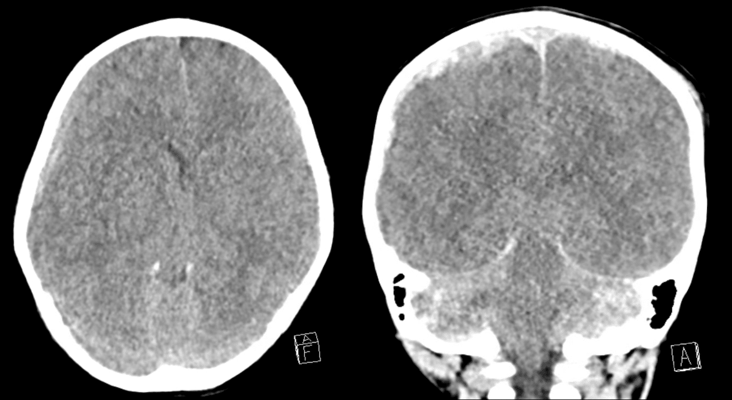 CT Case 002 LITFL CT Scan Interpretation