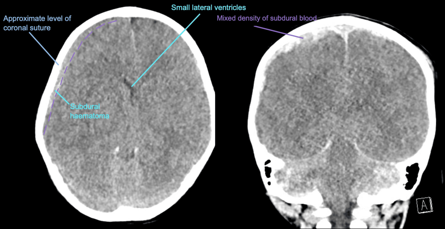 CT Case 002 LITFL CT Scan Interpretation