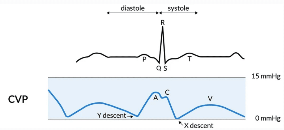 Arterial line and Pressure Transducer • LITFL • CCC Equipment