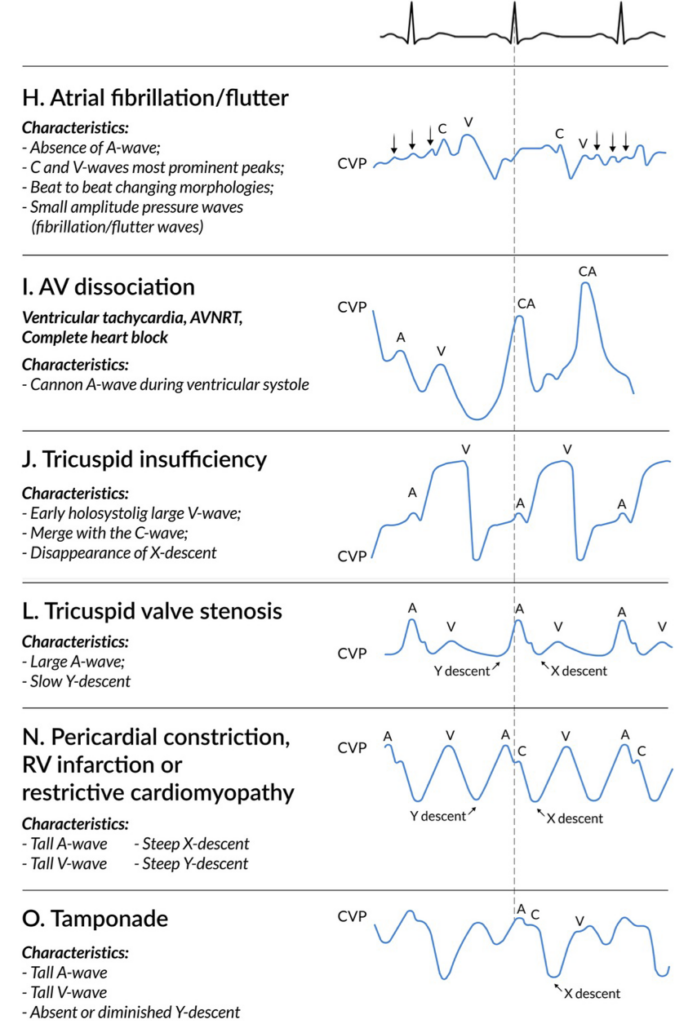 Analysis Of Central Venous Pressure (CVP) Signals Using, 49% OFF