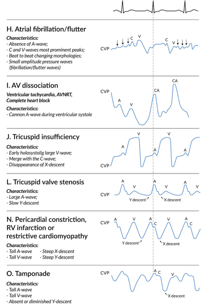 RA CVP Waveform Interpretation Central Venous Pressure 56 OFF
