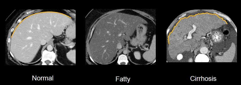 Liver Segmental Anatomy Ct Scan