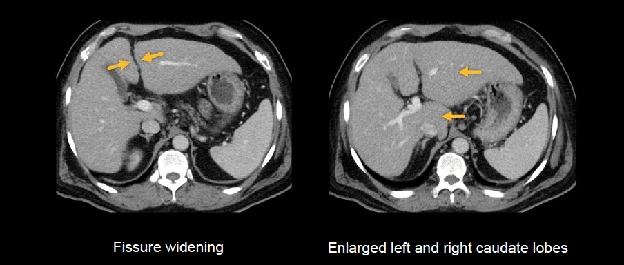 Cirrhosis Ct Scan