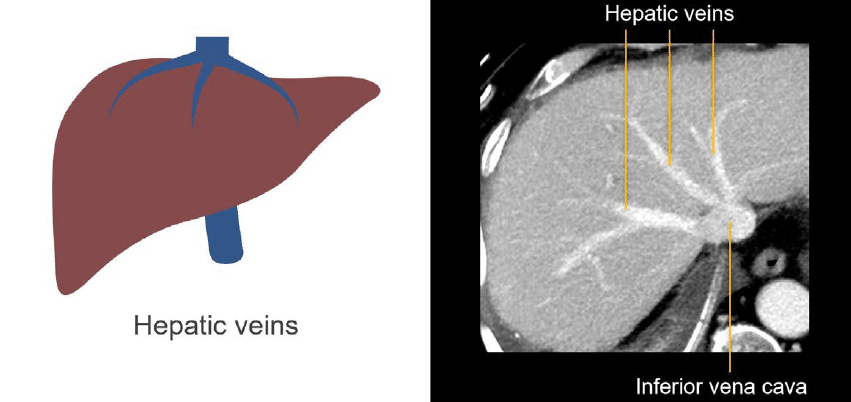Abdominal CT Liver LITFL Radiology Library Abdominal CT Liver LITFL Radiology Library