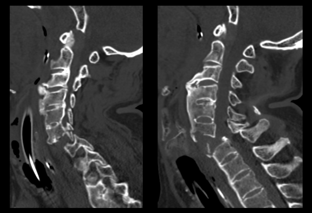 CT Case 017 CT cervical spine 01