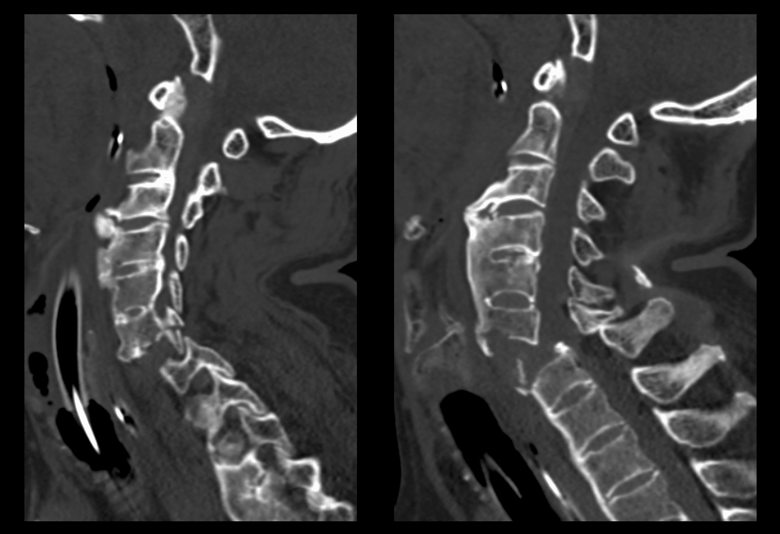 Cervical spine CT scan