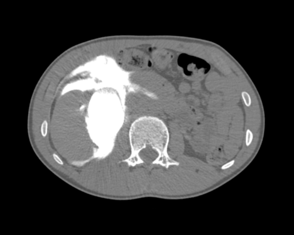 CT Case 043 02