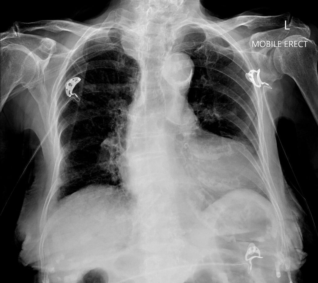 CT Case 045 CXR 1