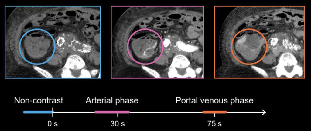 Abdominal CT Phases LITFL Radiology Library