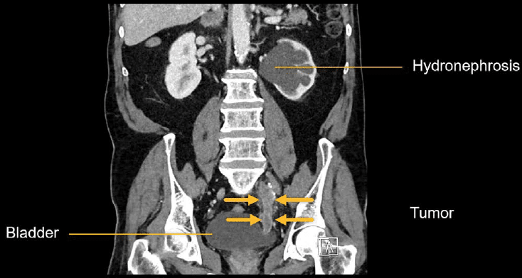 abdominal-ct-flank-pain-litfl-radiology-library