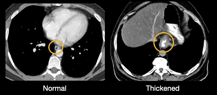 Abdominal CT: oesophagus and stomach • LITFL • Radiology