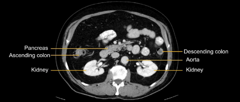 abdominal-ct-peritoneal-cavity-litfl-radiology-library