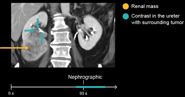 Mass of the right flank.  Download Scientific Diagram