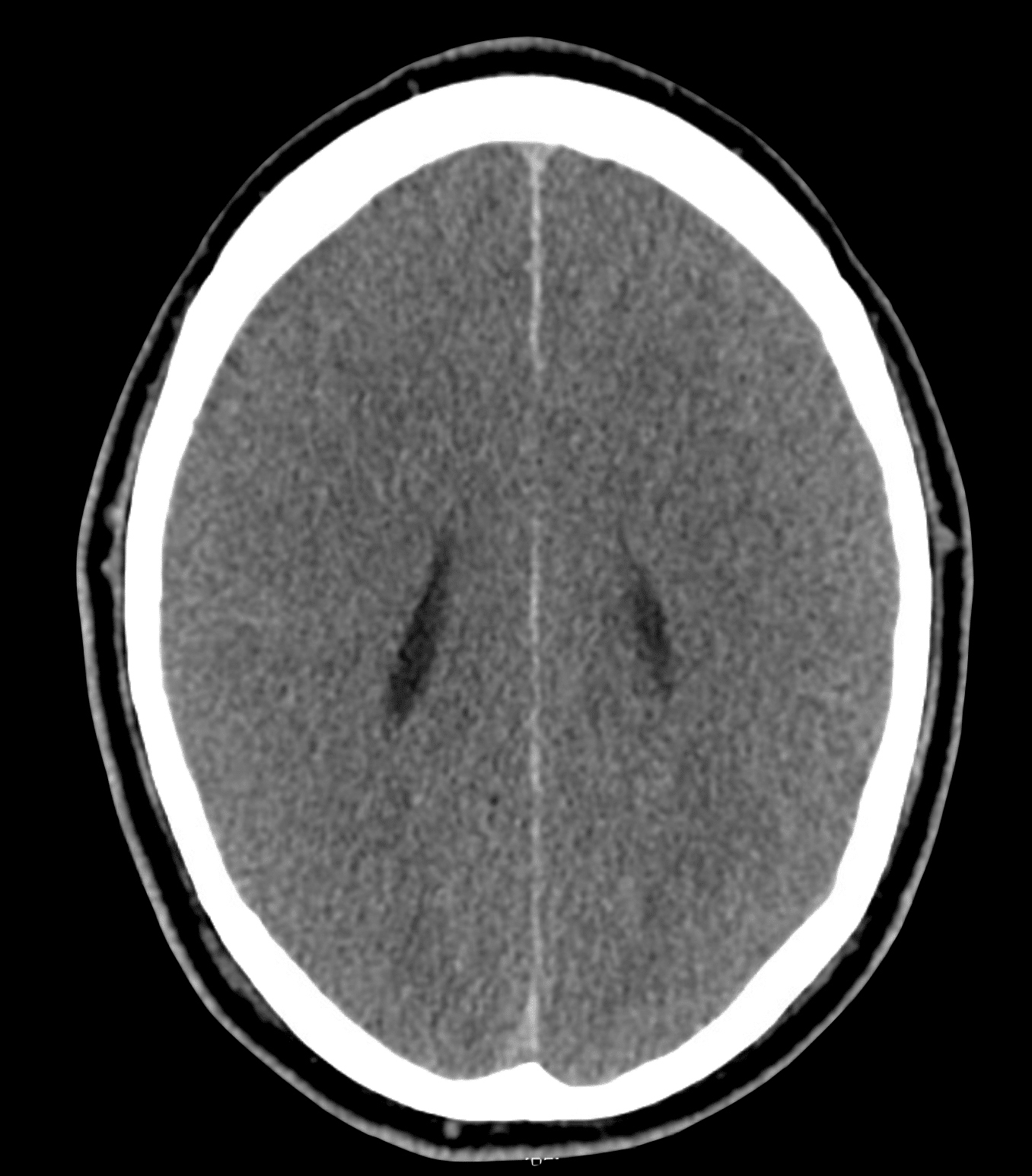 CT Case 011 LITFL CT Scan Interpretation