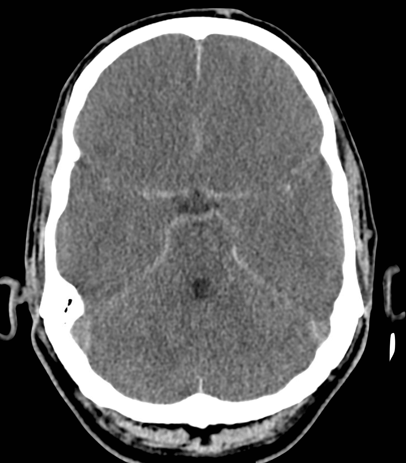 CT Case 011 LITFL CT Scan Interpretation
