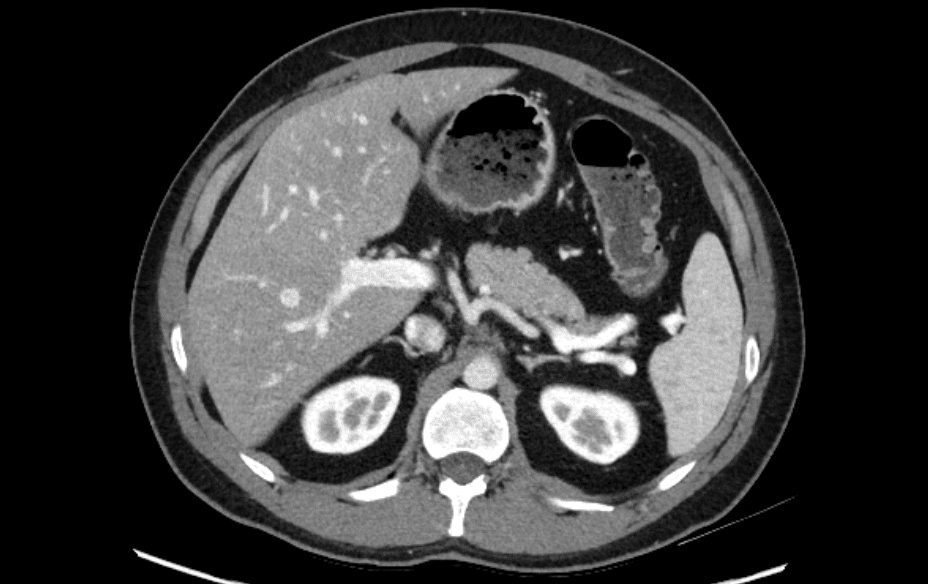 Medmastery interactive PACS CT abdomen spleen