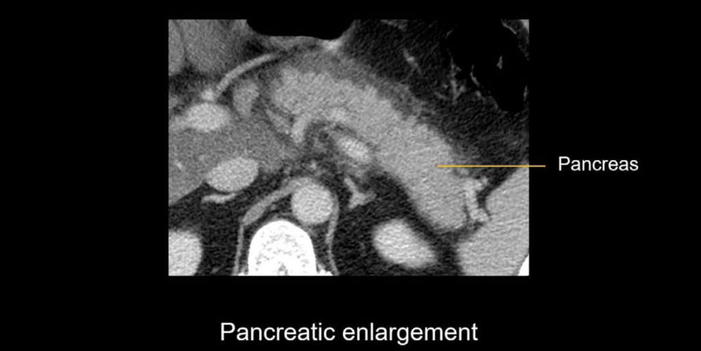 CT abdomen interstitial pancreatitis 1