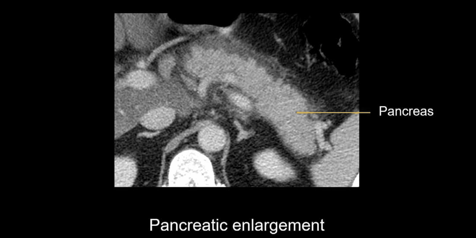 Abdominal CT: interstitial pancreatitis • LITFL • Radiology Library