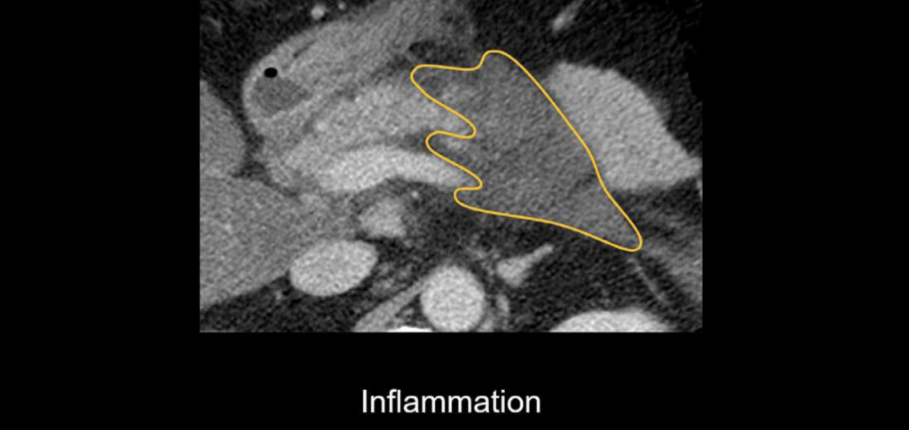 CT abdomen interstitial pancreatitis 2