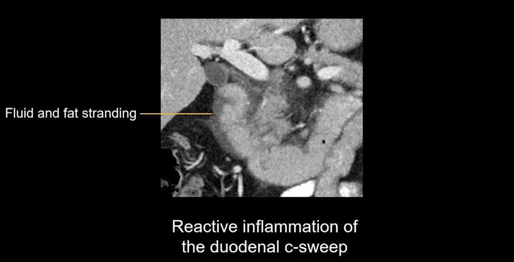 CT abdomen interstitial pancreatitis 3