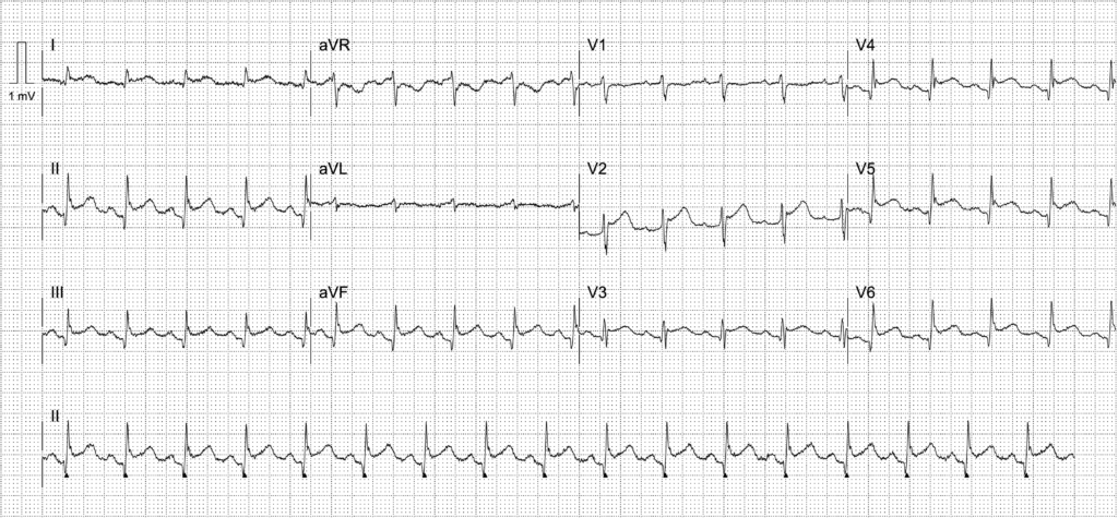 Activate or wait ECG 0957 LITFL