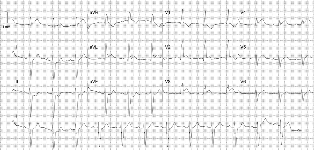 Activate or wait ECG 2295 LITFL