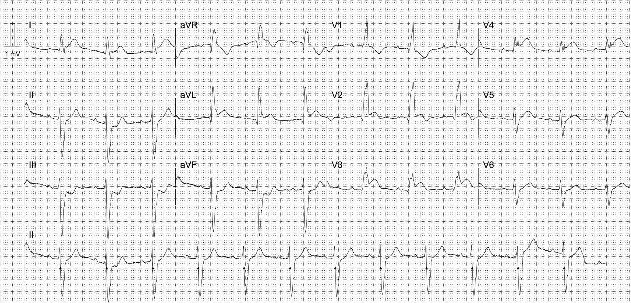 Activate or Wait - 009 • LITFL • Top 100 ECG