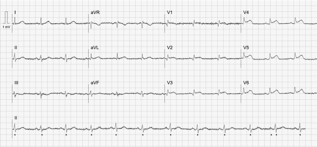 Activate or wait ECG 2354 01 LITFL