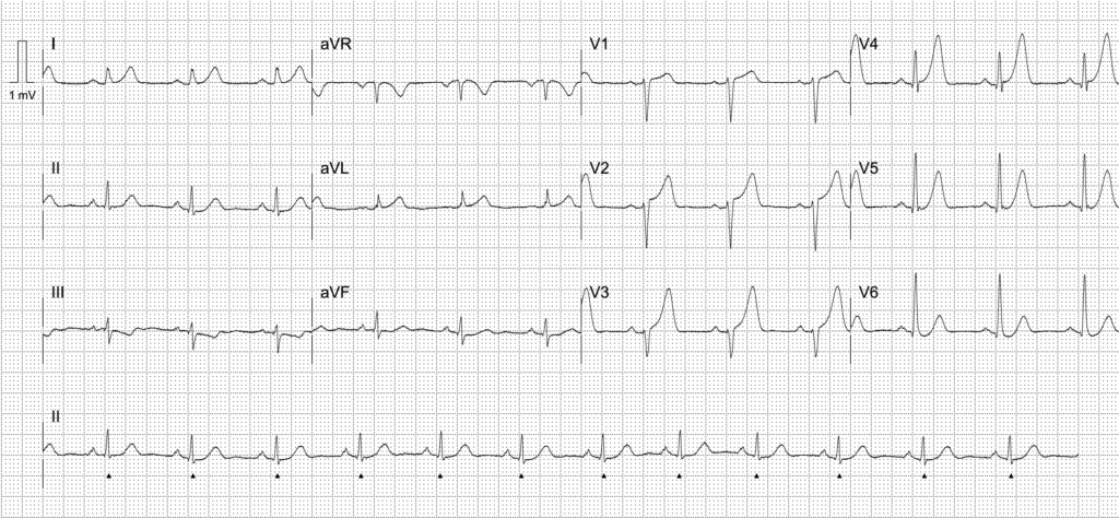 Activate or wait ECG 2411 LITFL