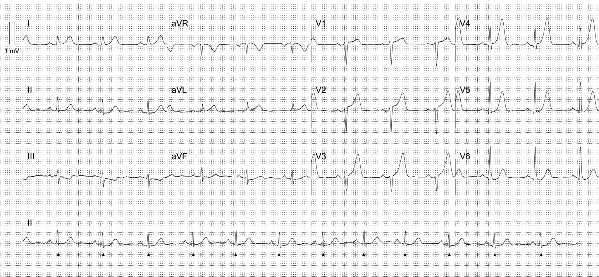 Activate Or Wait - 005 • Litfl • Top 100 Ecg