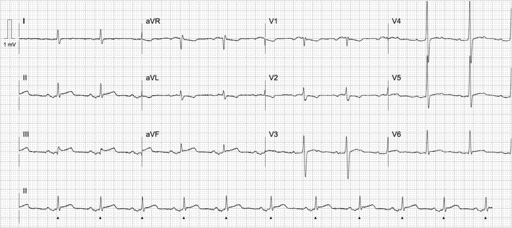 Activate or wait ECG 2562 LITFL