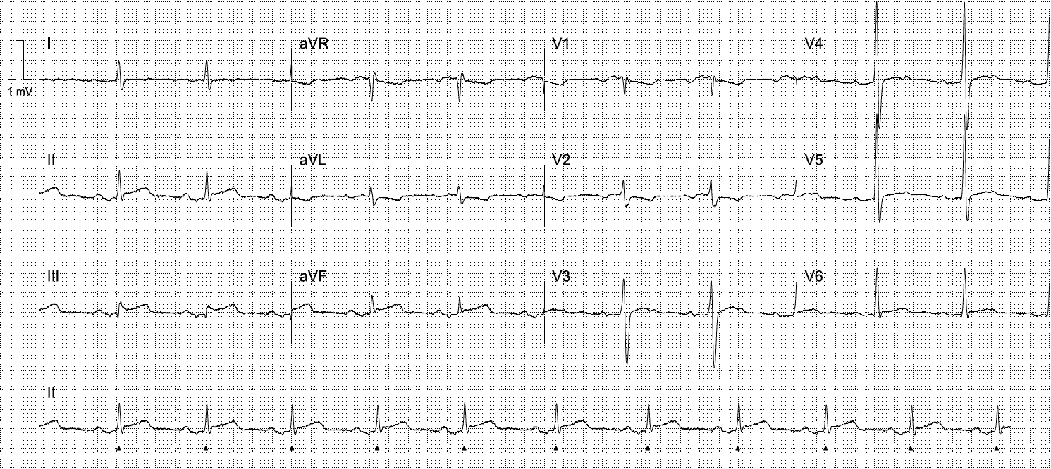 Activate or Wait - 003 • LITFL • Top 100 ECG